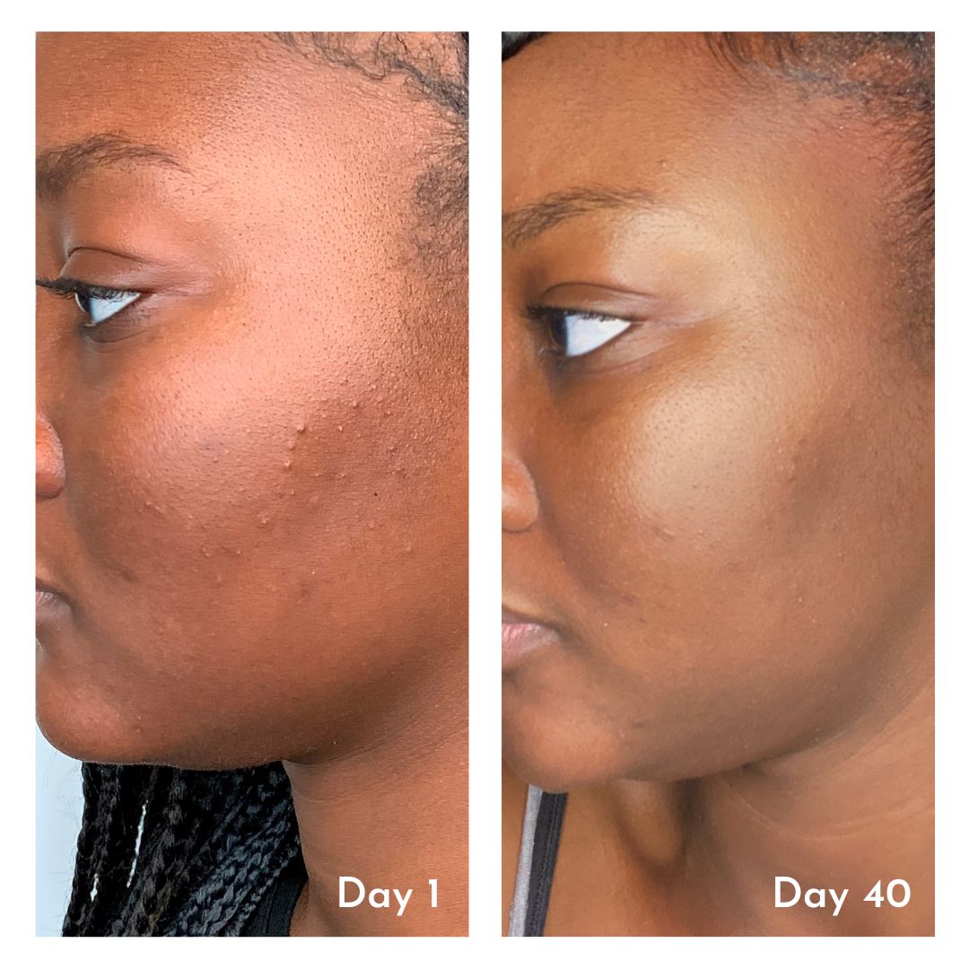 before and after skincare photo