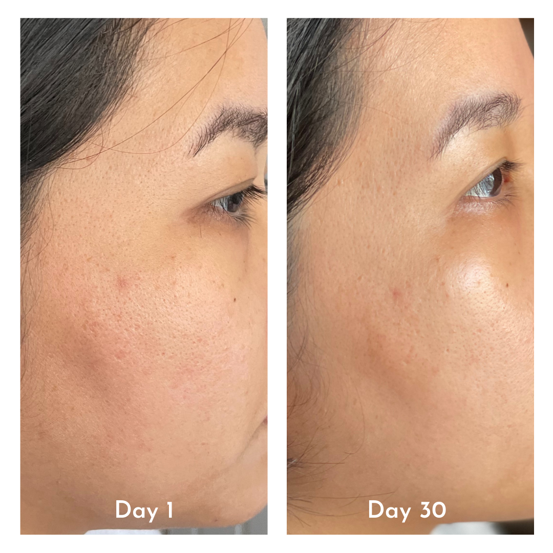 before and after skincare photo